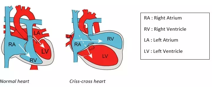 Criss-cross heart : how a shortage of cells affects the shape of the